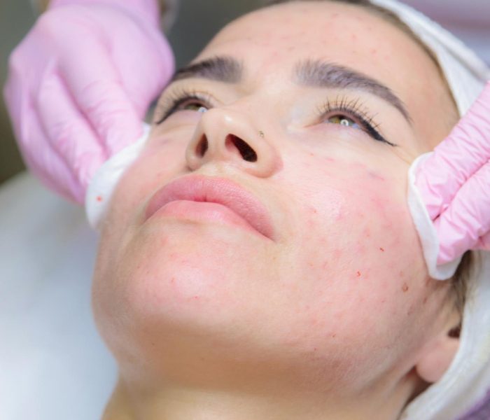 Peeling para acné